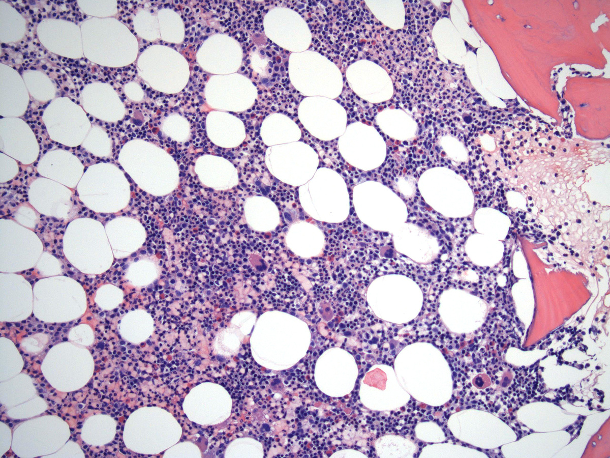 Bone Marrow biopsy_1